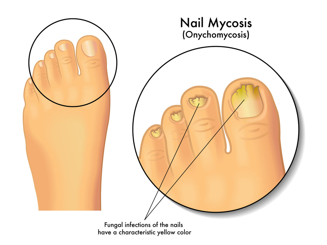 5 Ways To Prevent Yourself From Getting Toenail Fungus